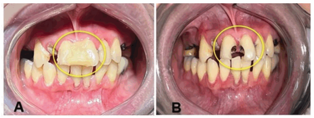 DIY fillings and the teeth once the fillings had been removed