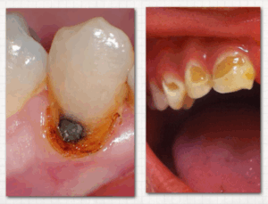 active caries vs. arrested caries