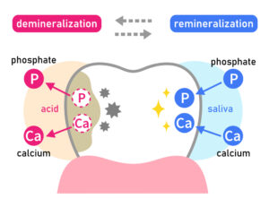 diagram demineralization vs remineralization
