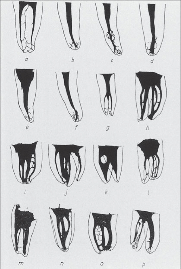 examples of complex root canal anatomy by Hess 1917