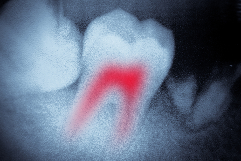 What to Know About Root Canals & Whole Body Health